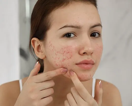 osoba wyciskająca pryszcze konsekwencje