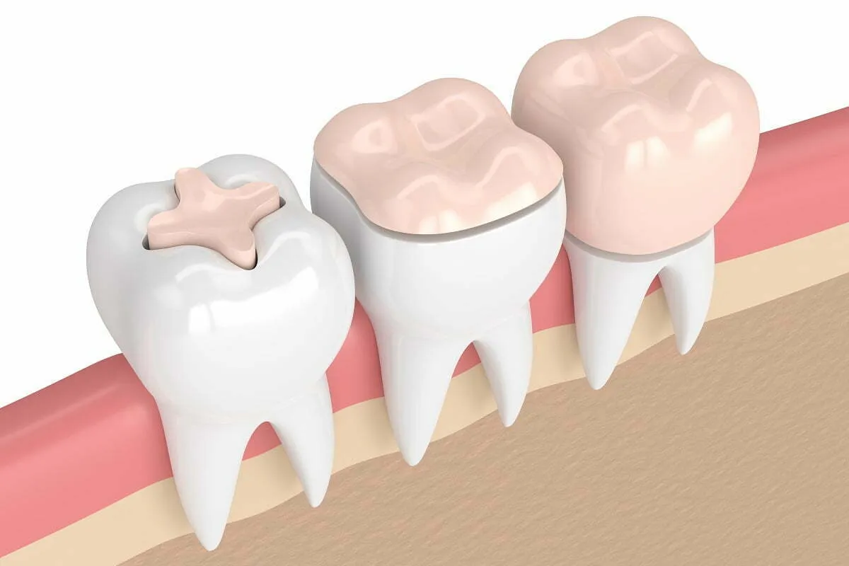 inlay onlay wypełnienie stomatologiczne