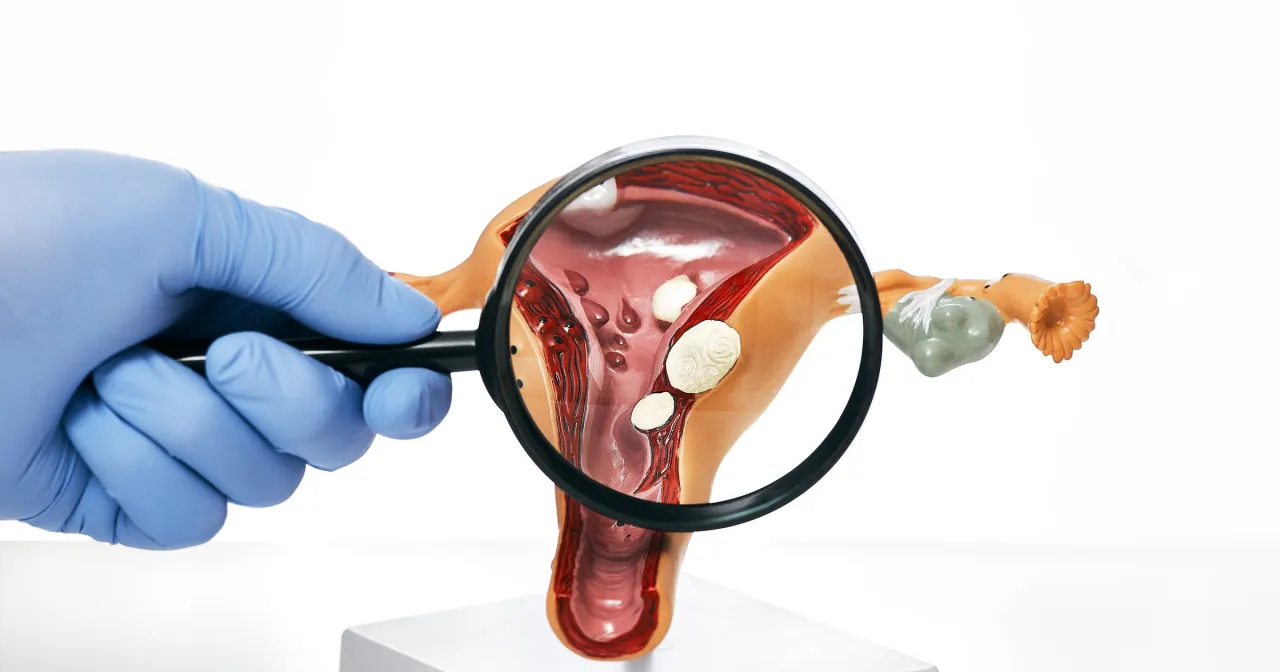 obrazek przedstawiający cykl hormonalny kobiety po 40 roku życia lub schemat macicy z mięśniakami/polipami