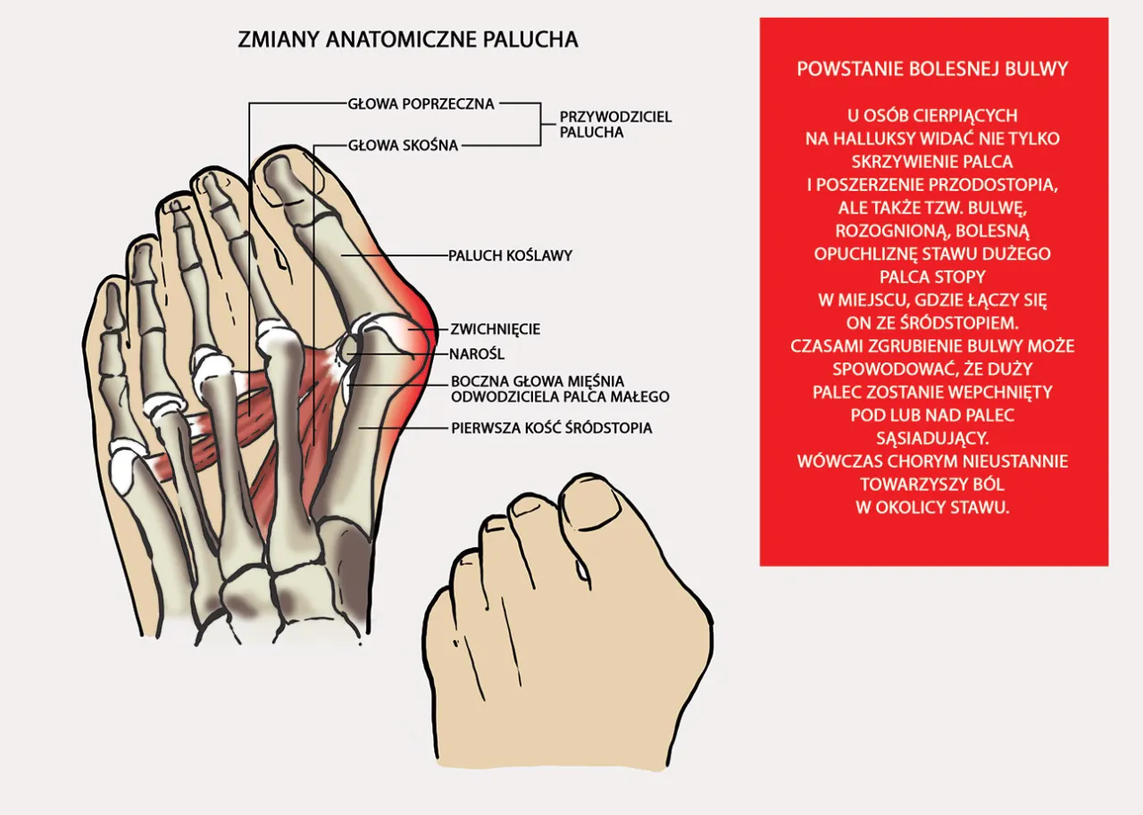 haluks anatomia stopy deformacja