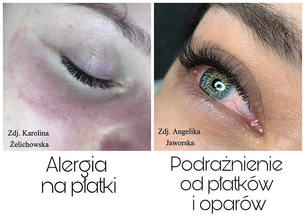 uczulenie podrażnienie rzęsy różnice