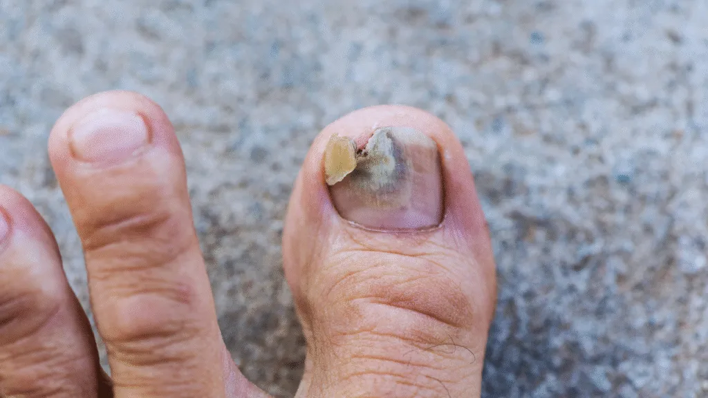 stłuczony paznokieć objawy i pierwsza pomoc