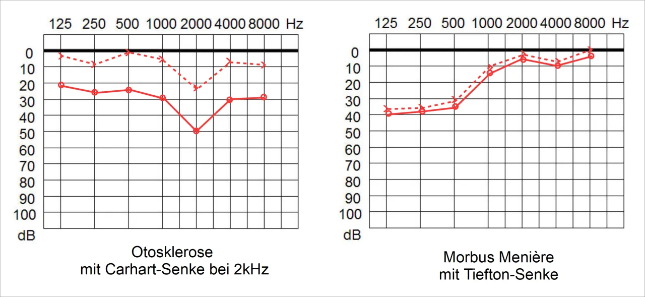 Audiogramm Morbus Meni&egrave;re