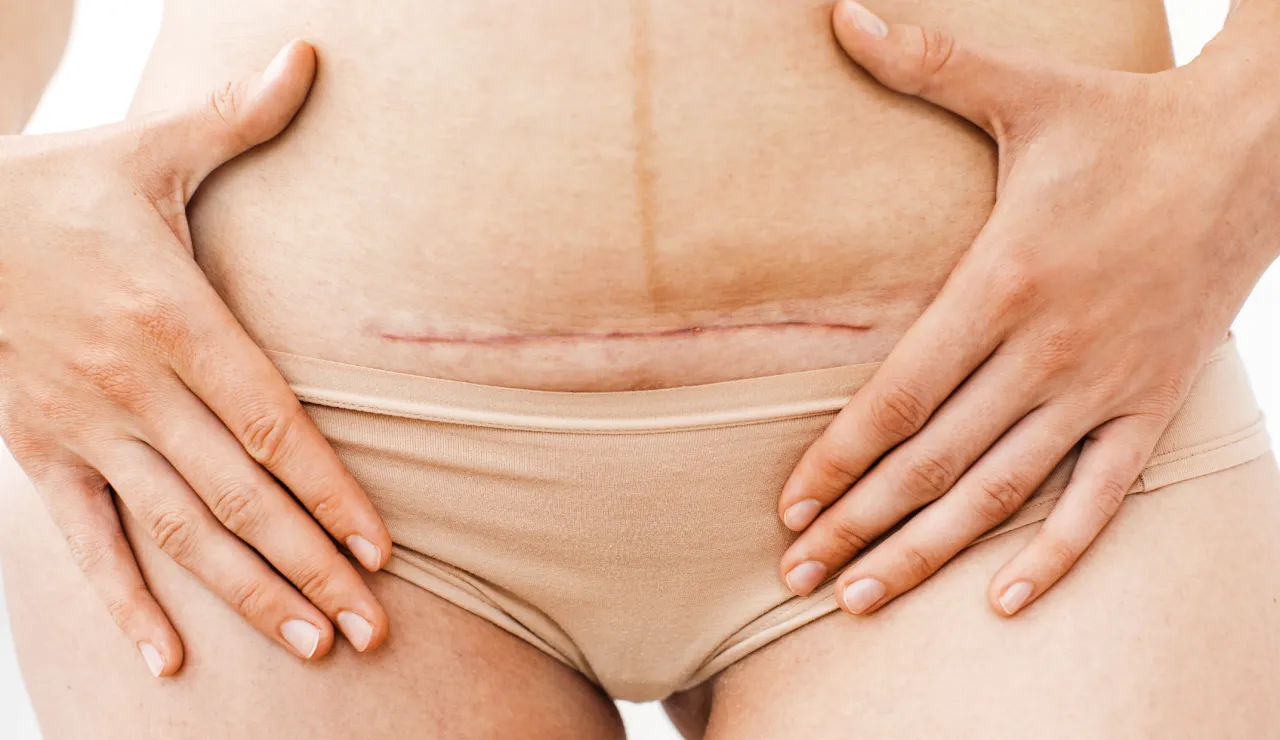 kobieta masuje bliznę po cesarce