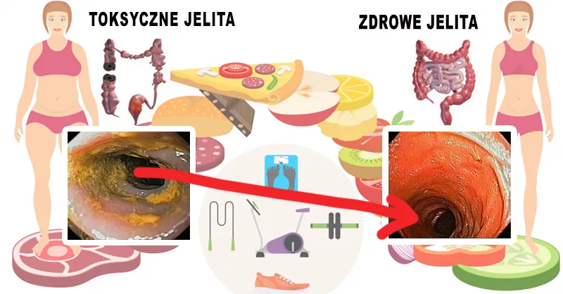 Zdjęcie Odbudowa flory jelitowej naturalnymi metodami. Jak poprawić kondycję jelit?