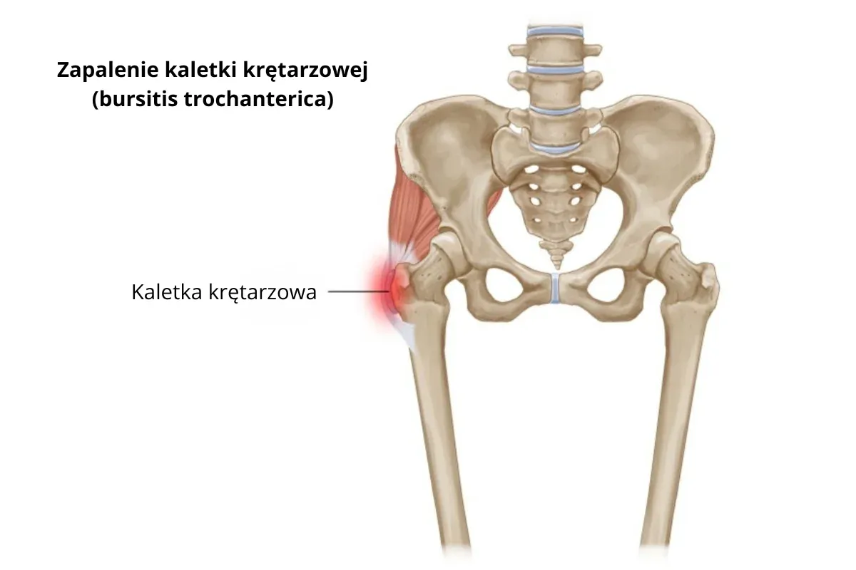 zastrzyk w biodro zapalenie kaletki krętarzowej