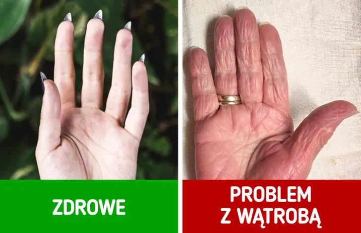 Objawy skórne chorej wątroby: żółtaczka, pajączki, rumień dłoniowy