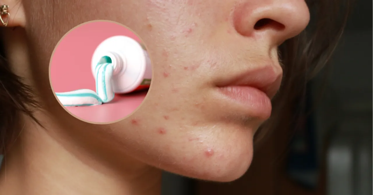 Czy maść cynkowa pomaga na pryszcze? Na zdjęciu widać twarz z niedoskonałościami i tubkę z pastą cynkową.