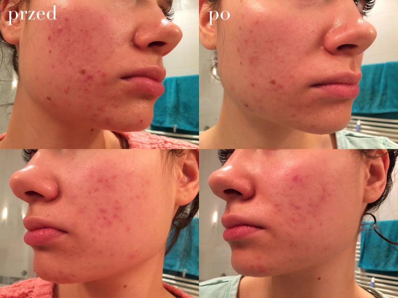 Sk&oacute;ra przed i po peelingu