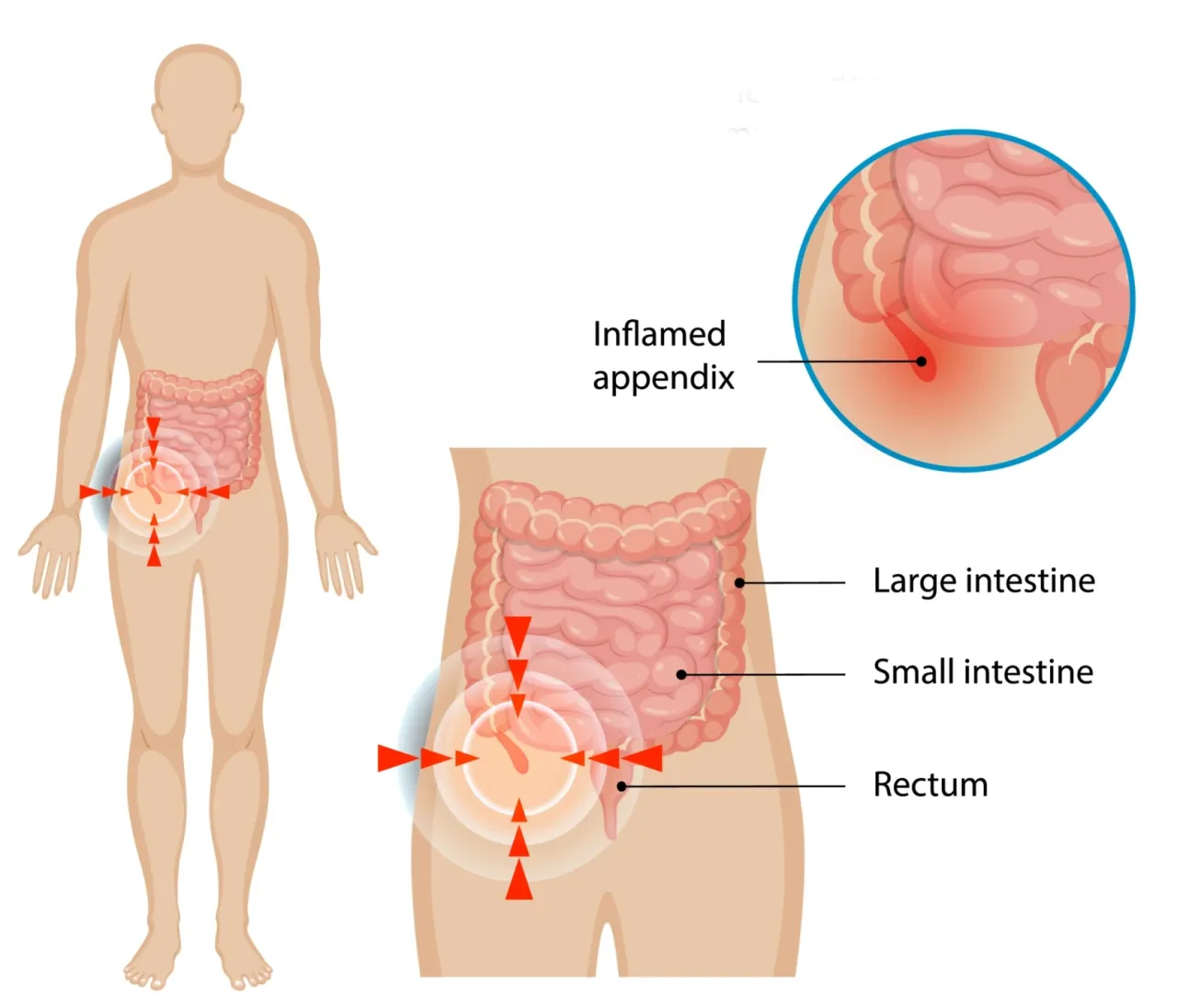 Mapa bólu brzucha przy zapaleniu wyrostka robaczkowego