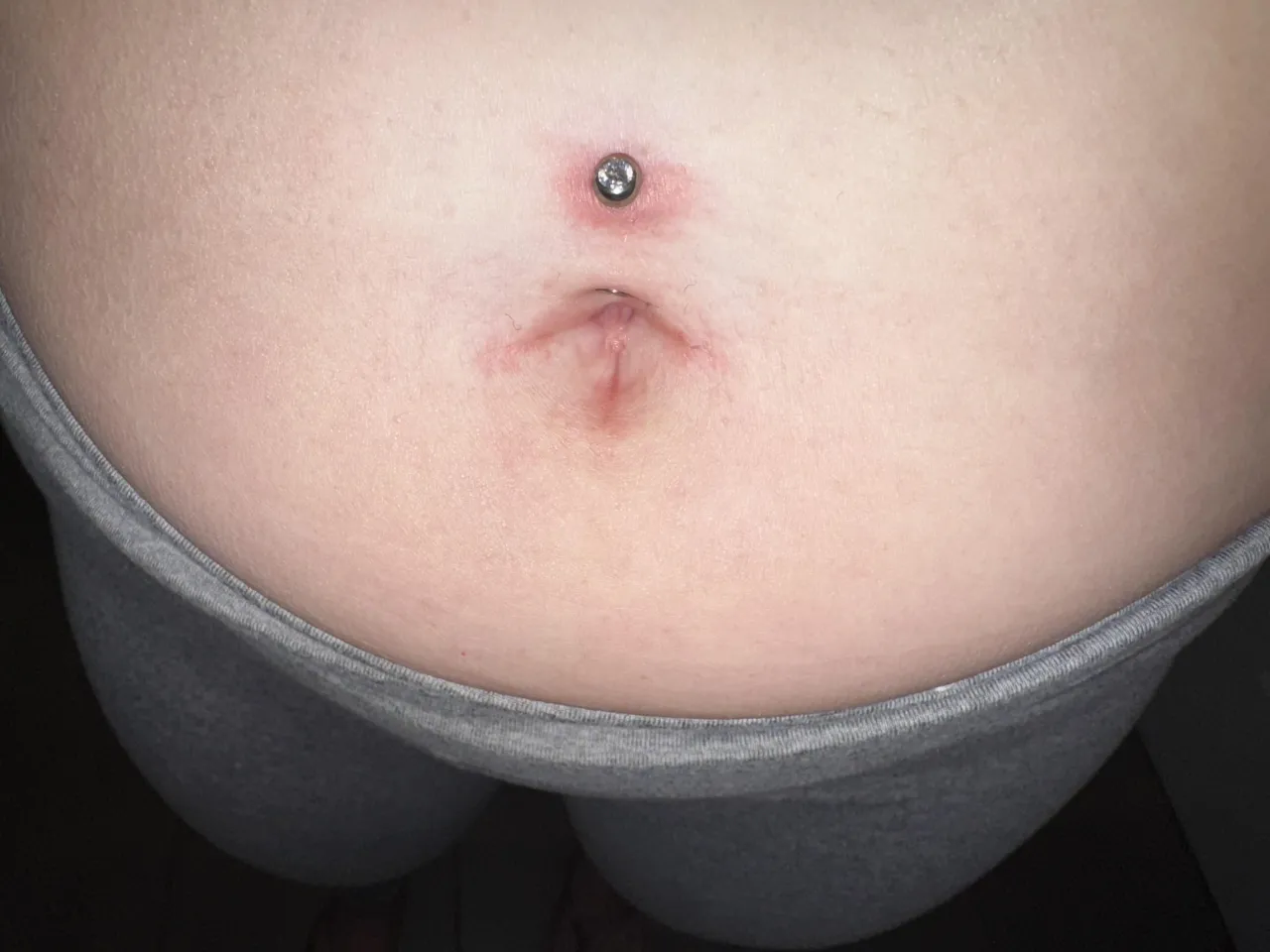 zdjęcie zdrowy kolczyk w pępku vs podrażniony