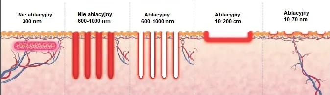 por&oacute;wnanie laser frakcyjny ablacyjny nieablacyjny