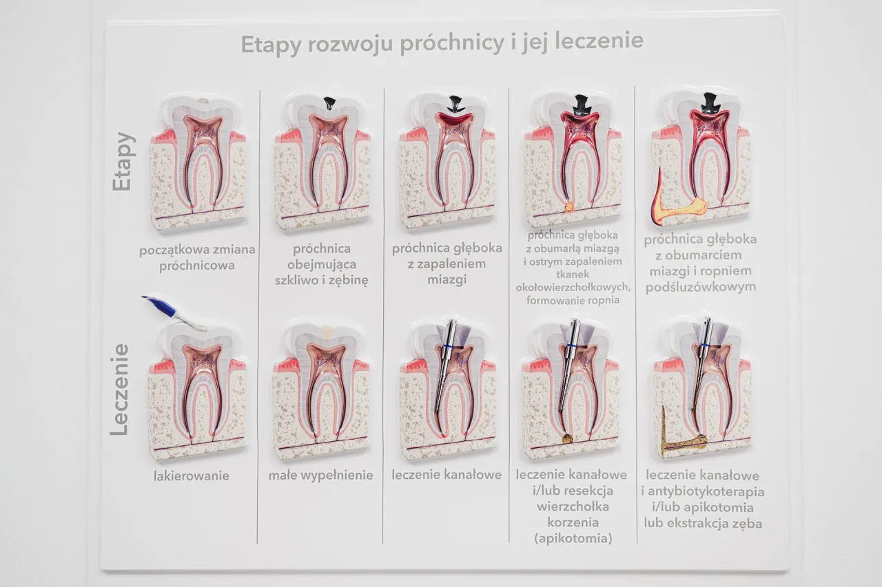 Pr&oacute;chnica zęba etapy
