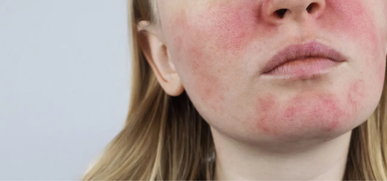 Lebensstil Einfluss Hautr&ouml;tungen