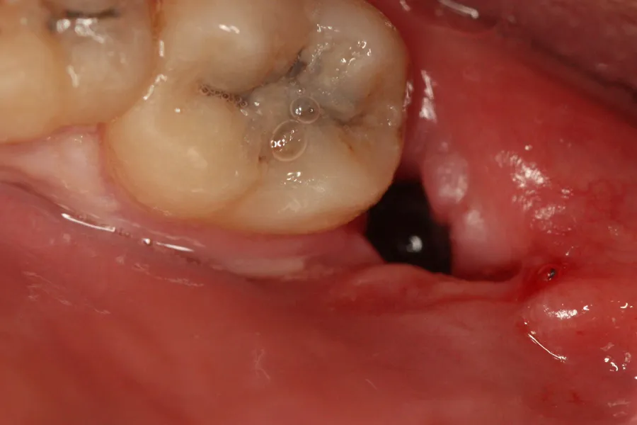 suchy zębod&oacute;ł objawy grafika