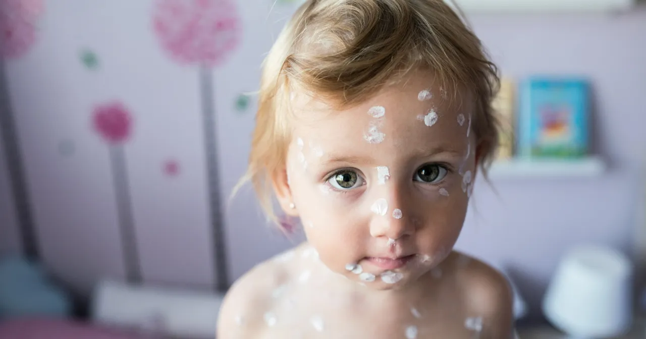 Kalendarz okres wylęgania ospy wietrznej i objawy