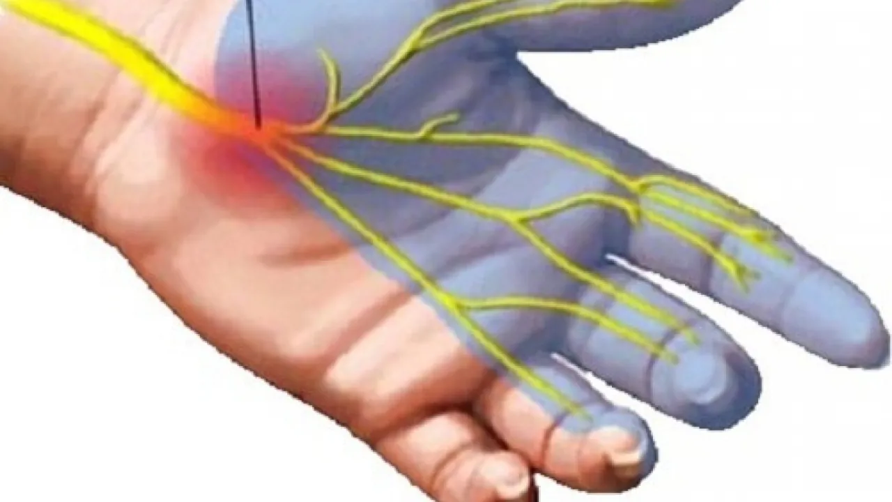 Zespół cieśni nadgarstka grafika ręka nerw