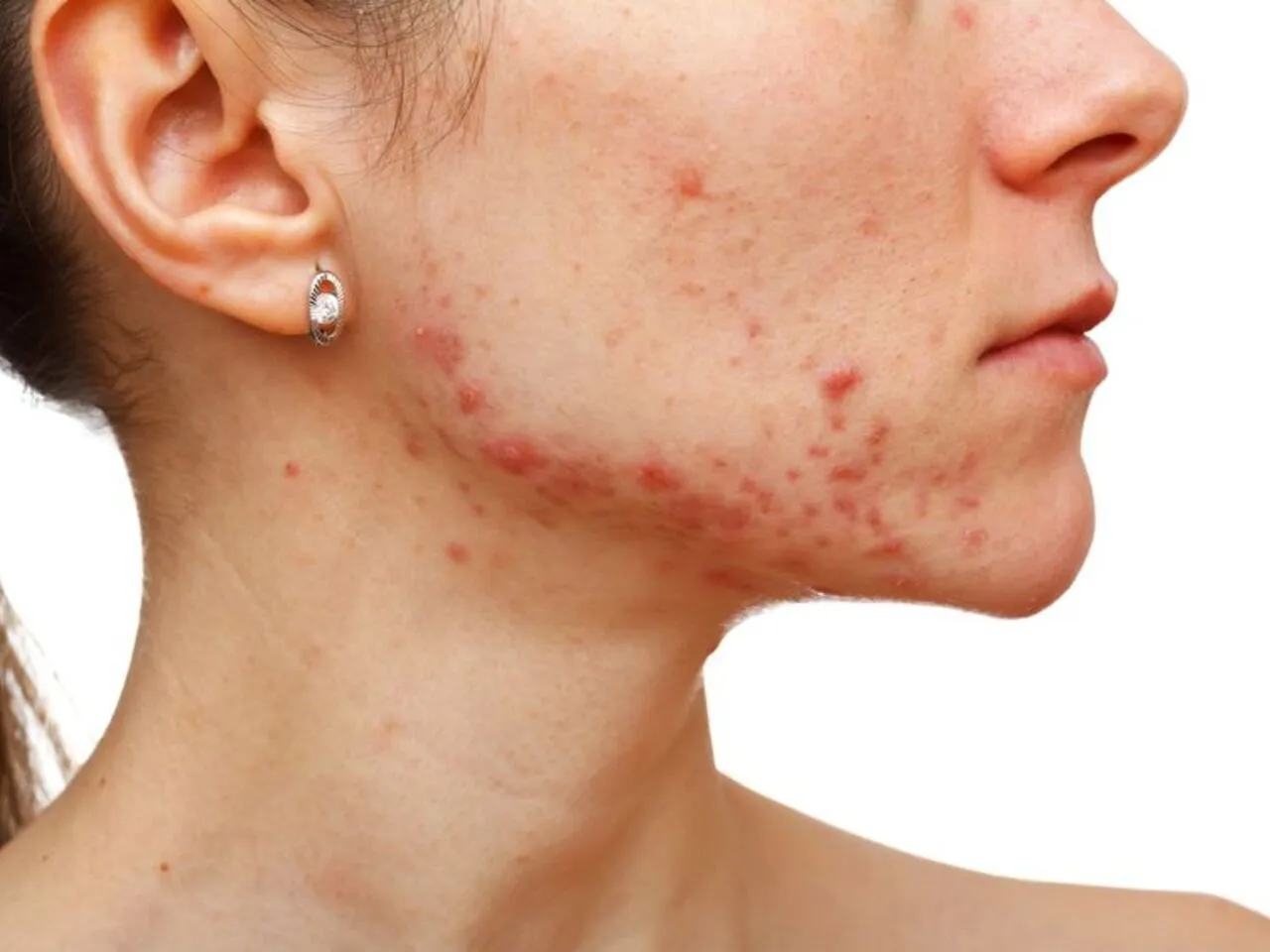 Trądzik hormonalny u kobiet objawy