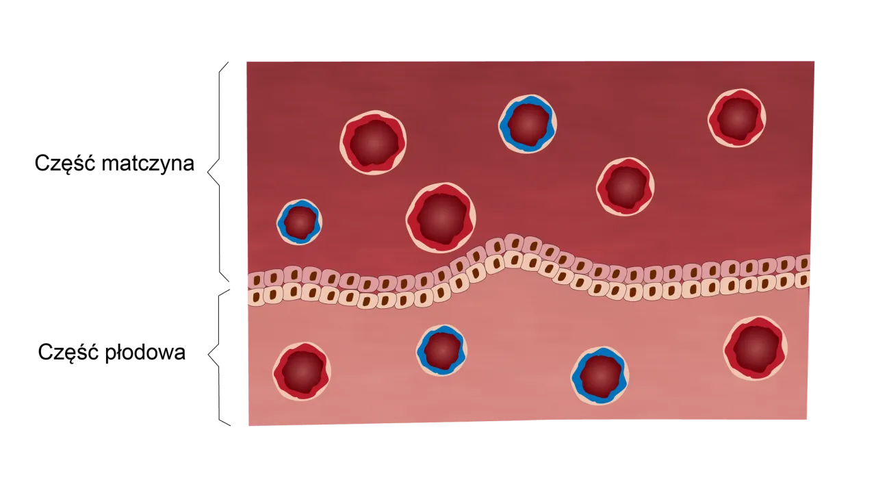 Rodzaje patologii łożyska grafika