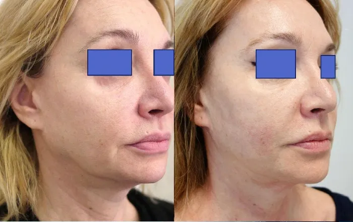 zabiegi aparaturowe twarz 50+ HIFU radiofrekwencja laser