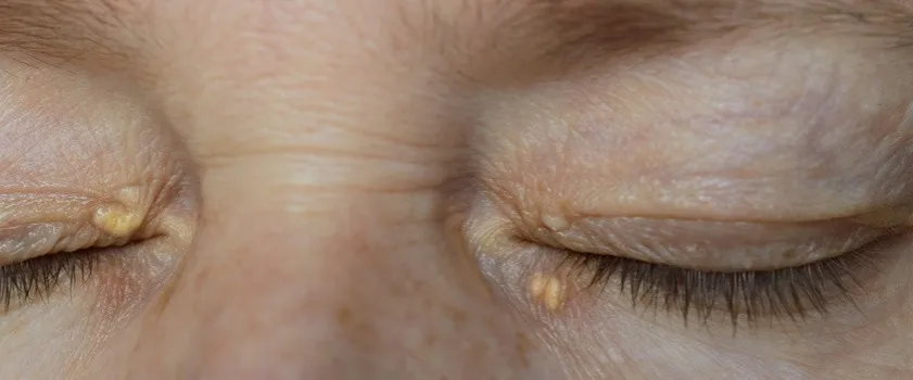 ż&oacute;łtaki kępki ż&oacute;łte na powiekach