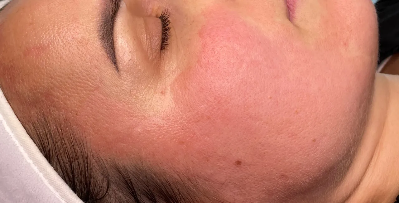 Skóra po laserze frakcyjnym bezpośrednio po zabiegu zaczerwienienie obrzęk
