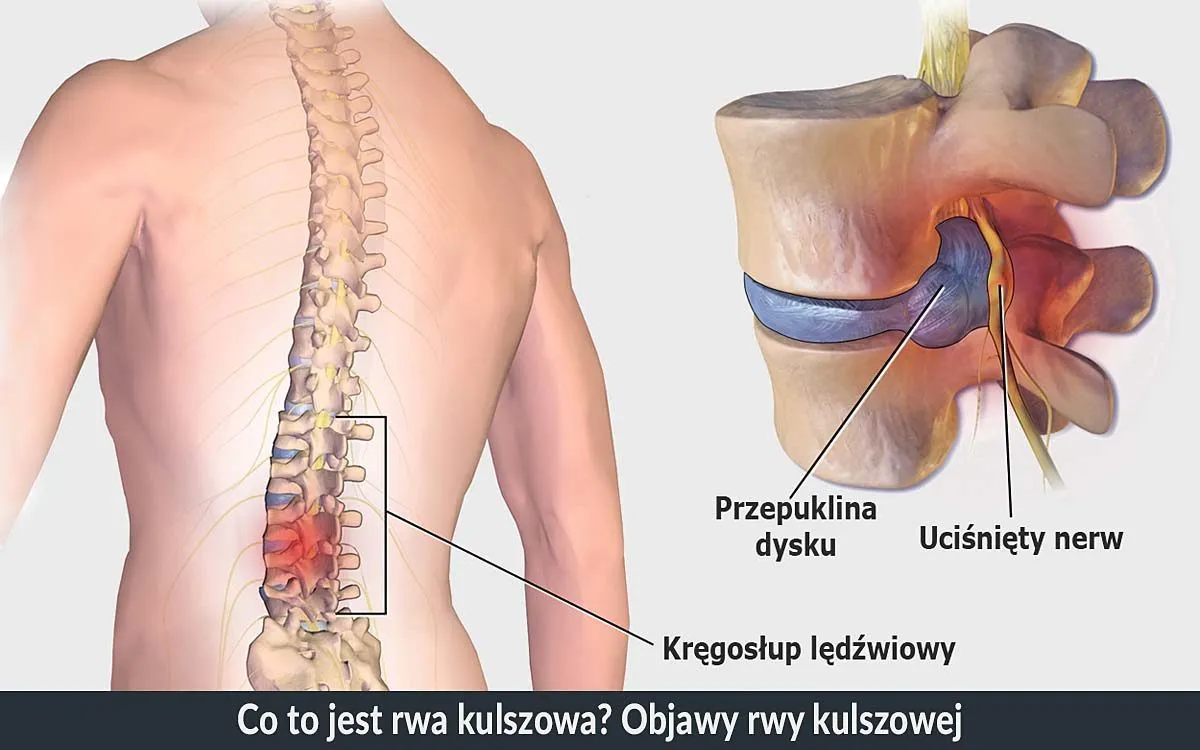 kręgosłup nerwy ucisk rwa kulszowa