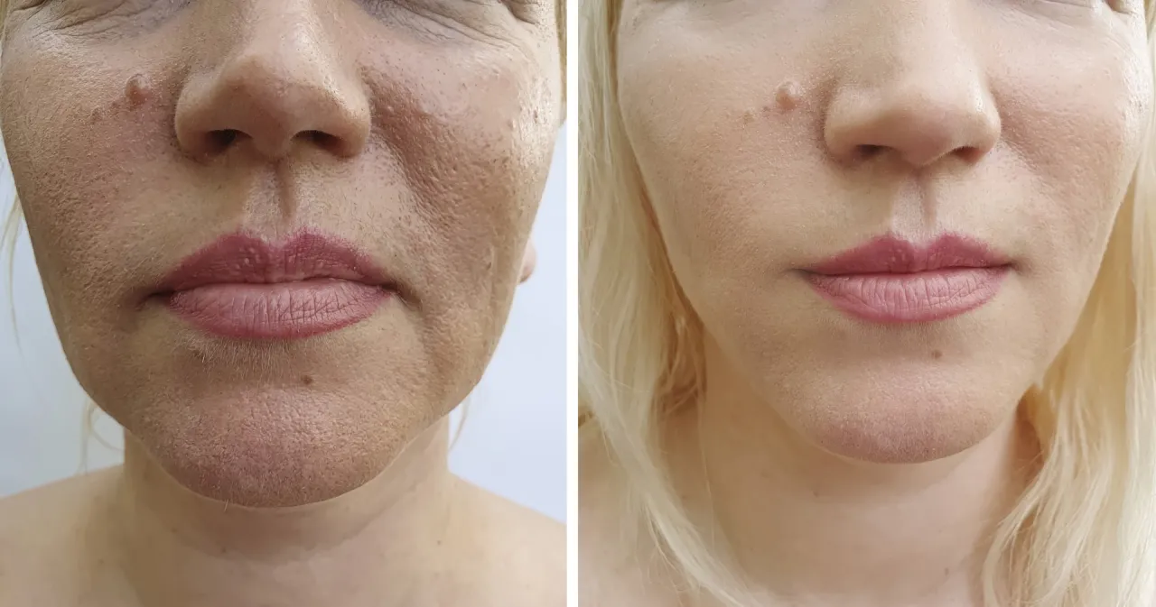 mezoterapia igłowa twarzy