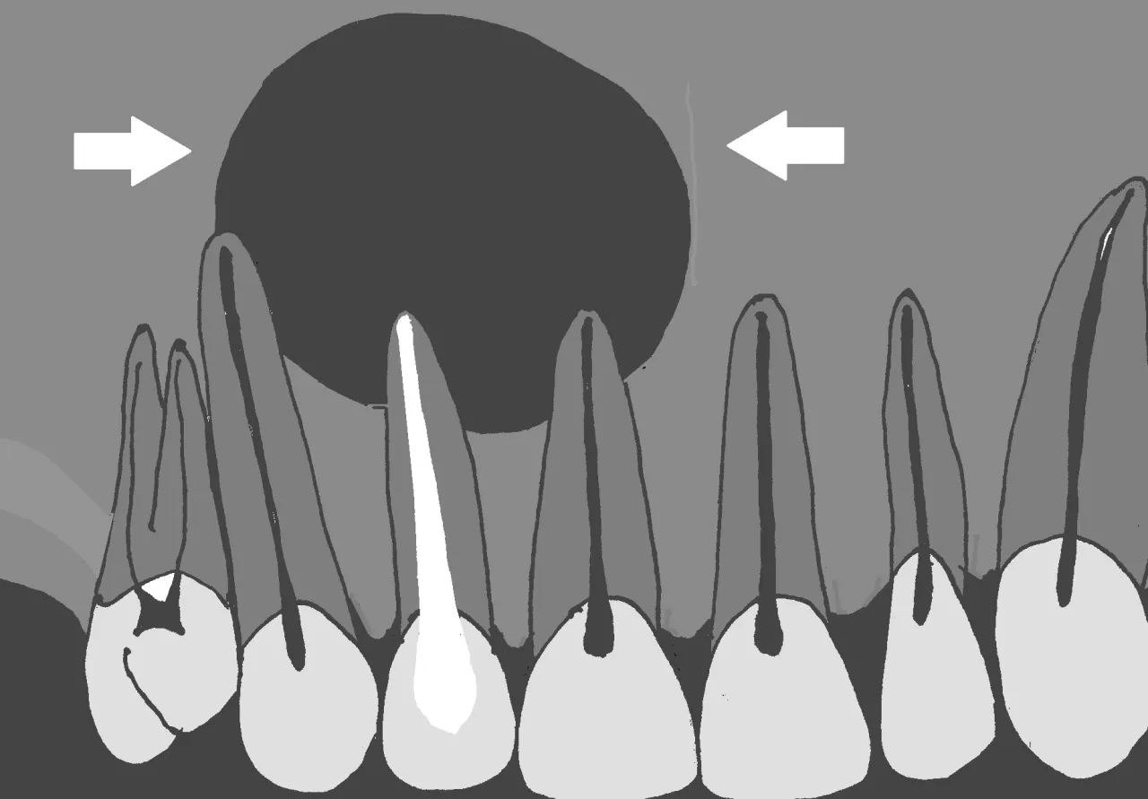 leczenie torbieli zęba schemat