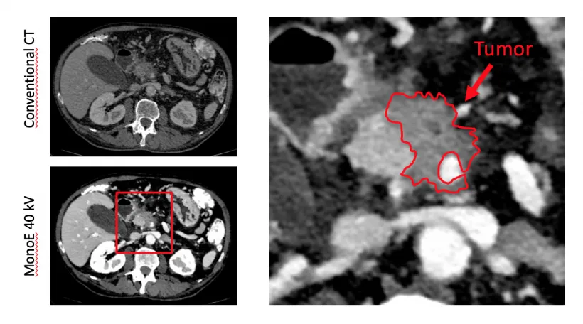 Bauchspeicheldrüse Ultraschall CT MRT