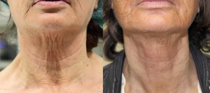 technologie liftingu szyi bez skalpela