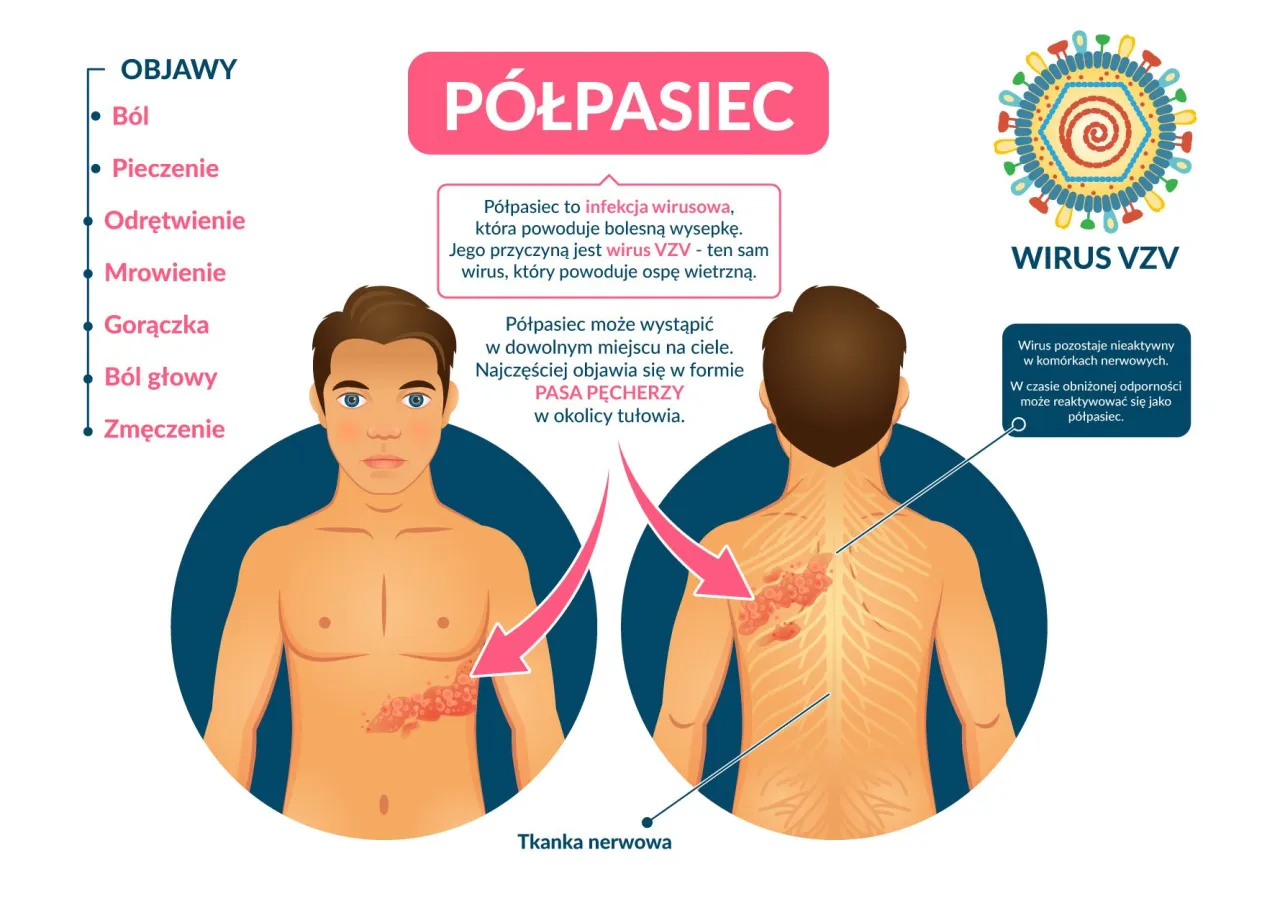 Objawy p&oacute;łpaśca: b&oacute;l, pieczenie, odrętwienie, mrowienie, gorączka, b&oacute;l głowy, zmęczenie. Jak złagodzić b&oacute;l przy p&oacute;łpaścu? P&oacute;łpasiec to wirus VZV.