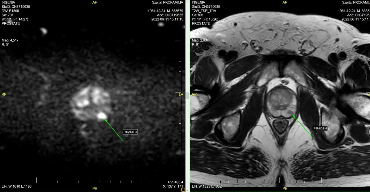 Przygotowanie do biopsji prostaty