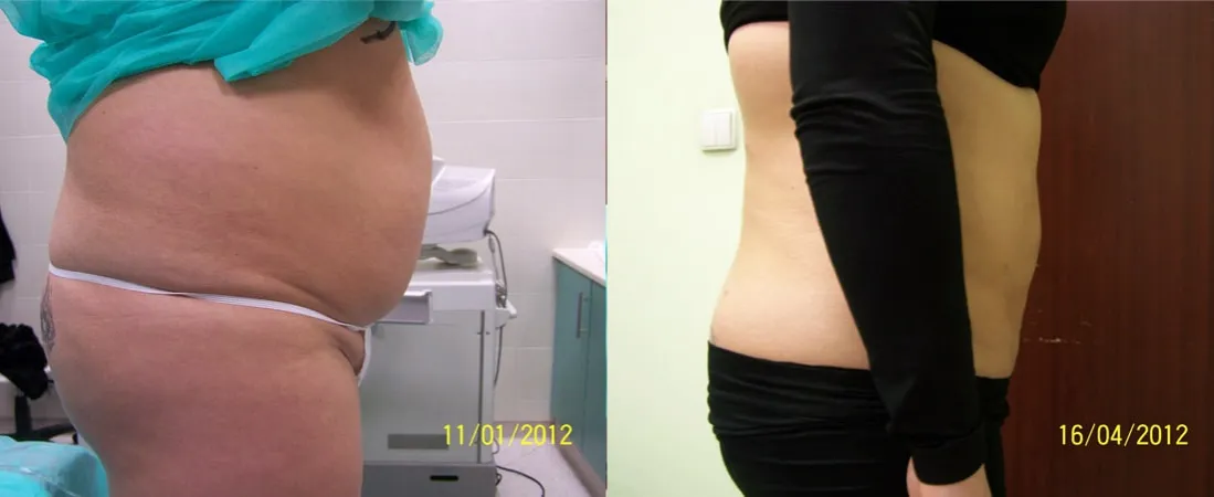 Porównanie metod liposukcji grafika