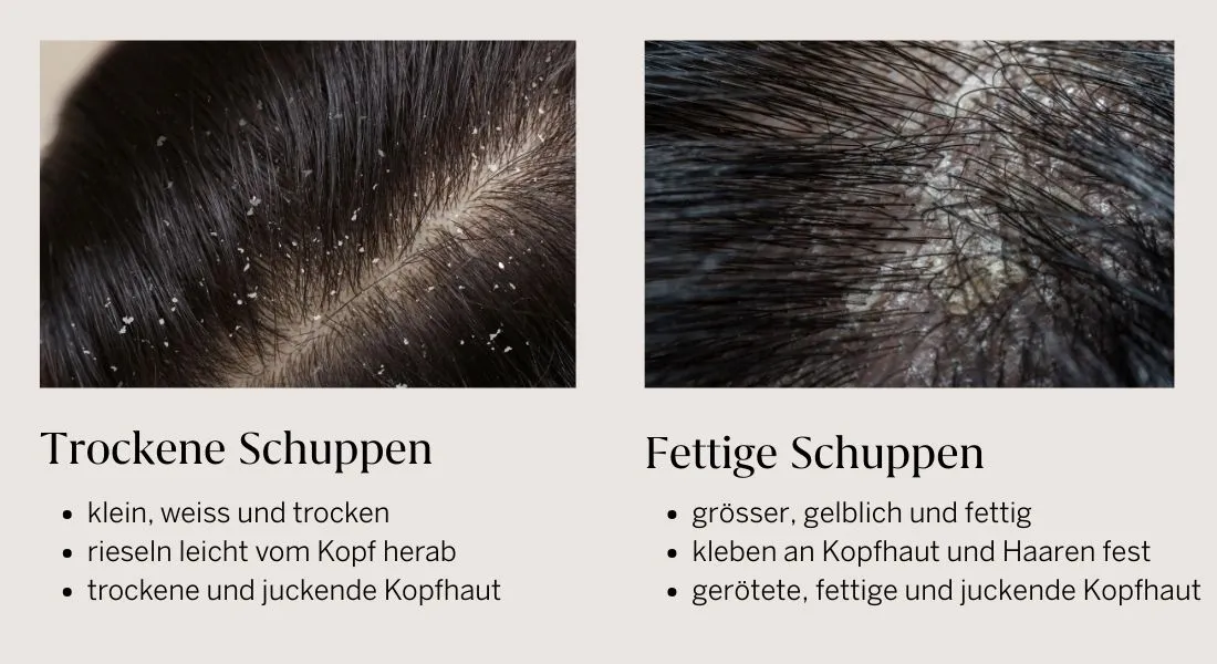verschiedene arten von schuppen trockene und fettige kopfhaut