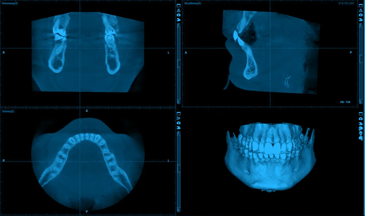 por&oacute;wnanie rtg punktowego pantomogramu i tomografii cbct