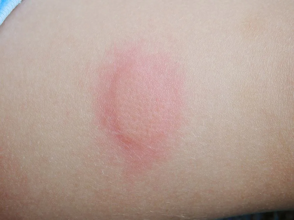 rumień guzowaty objawy na skórze