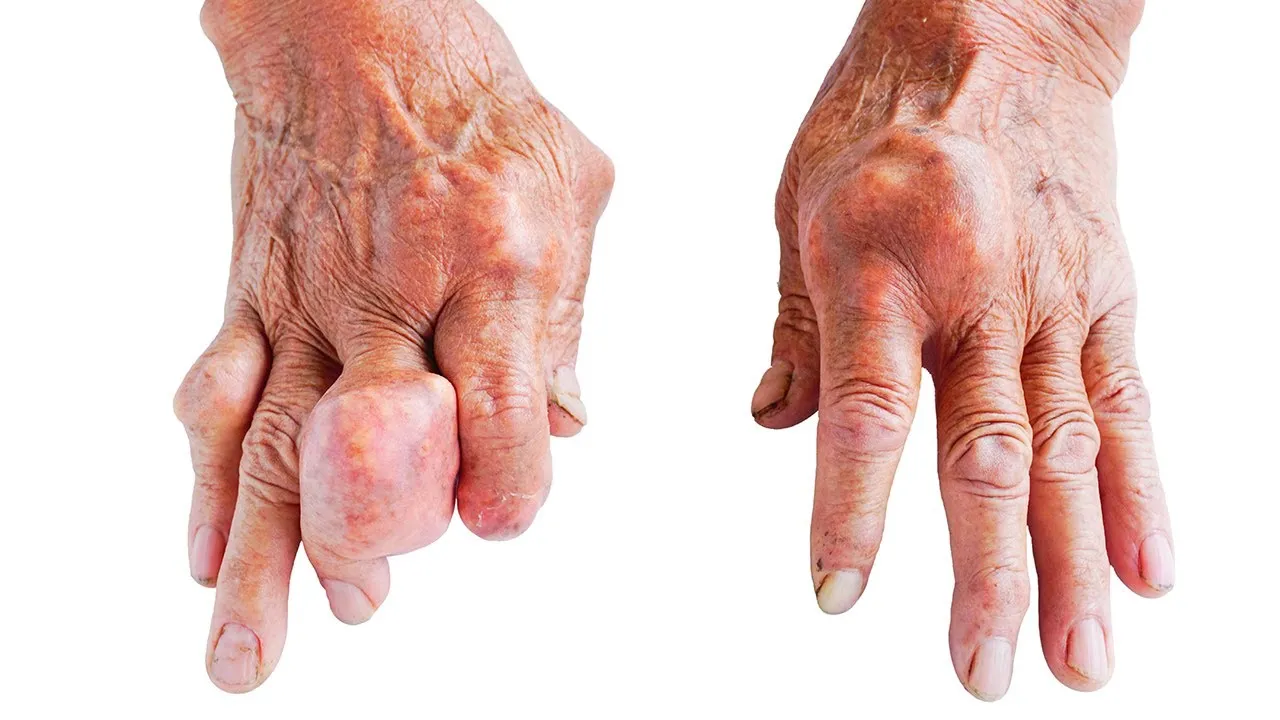 objawy dny moczanowej