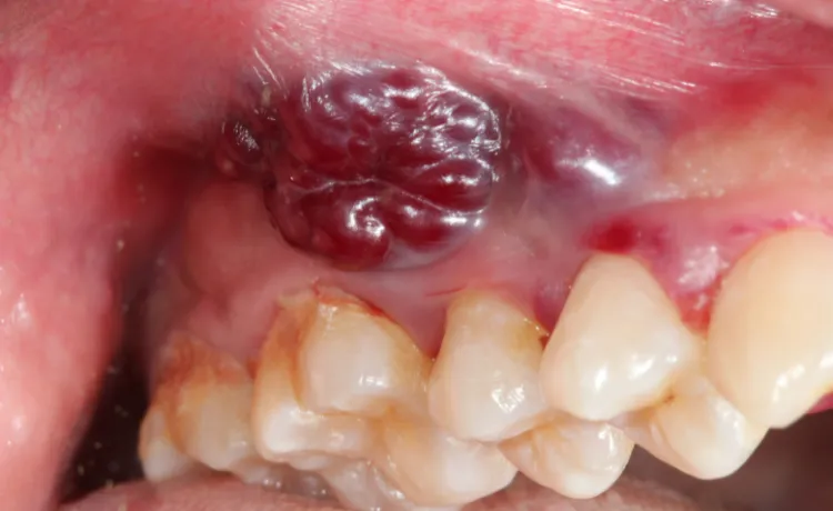 Mapa lokalizacji raka jamy ustnej język dno jamy ustnej dziąsła