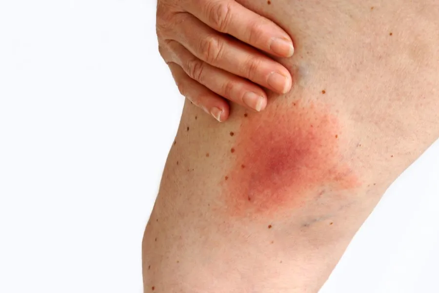 typowa reakcja sk&oacute;ry po ugryzieniu kleszcza