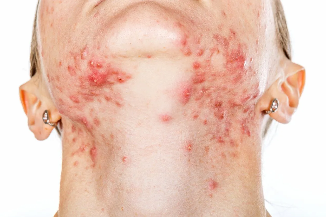 Widoczne liczne pryszcze na szyi i żuchwie. Mogą oznaczać problemy hormonalne lub reakcję alergiczną.