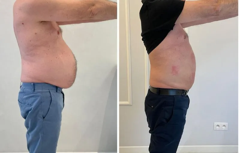 liposukcja przed i po centymetry