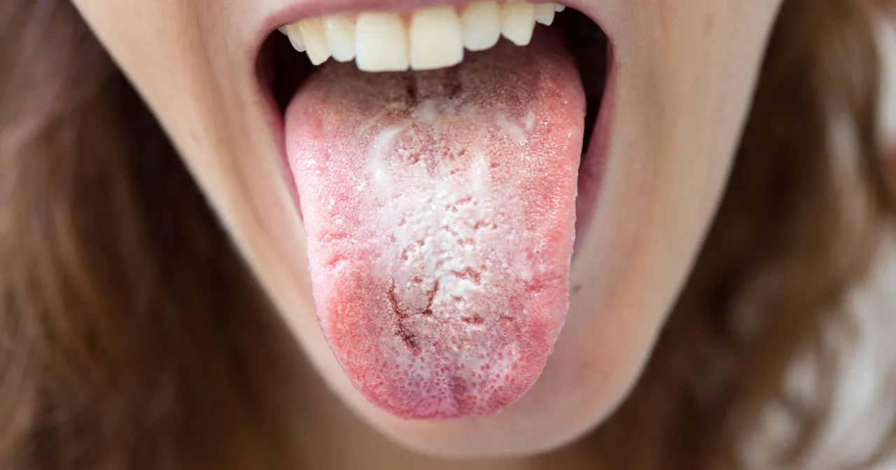 Grzybica jamy ustnej objawy nalot język