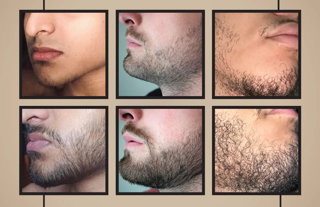 Minoksydyl dermaroller zarost