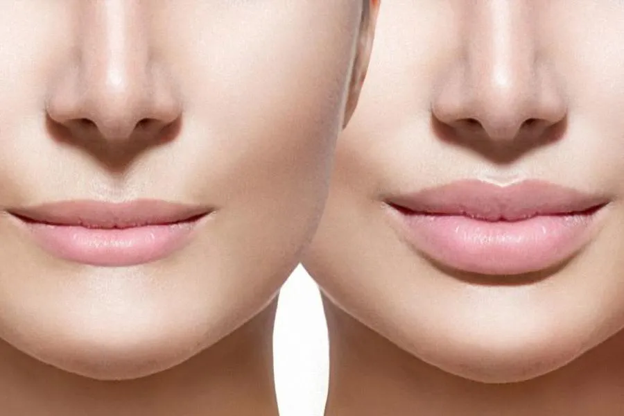 powiększanie ust kwasem hialuronowym przed i po