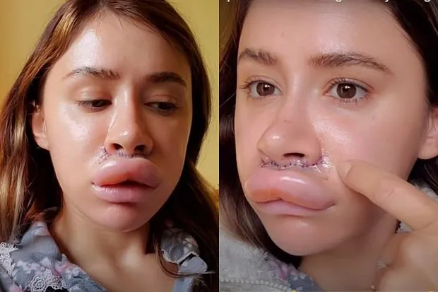 kobieta z chłodnym okładem na ustach po zabiegu