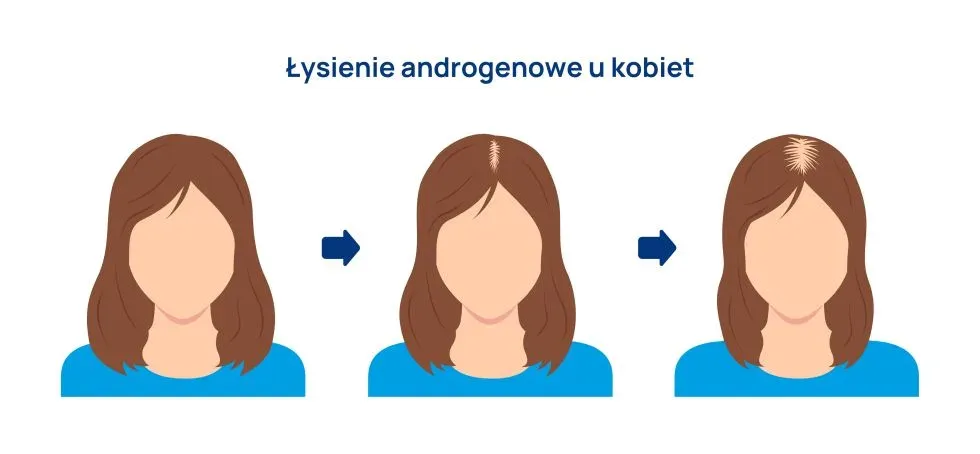 Zdjęcie Łysienie androgenowe u kobiet: objawy, przyczyny i wpływ