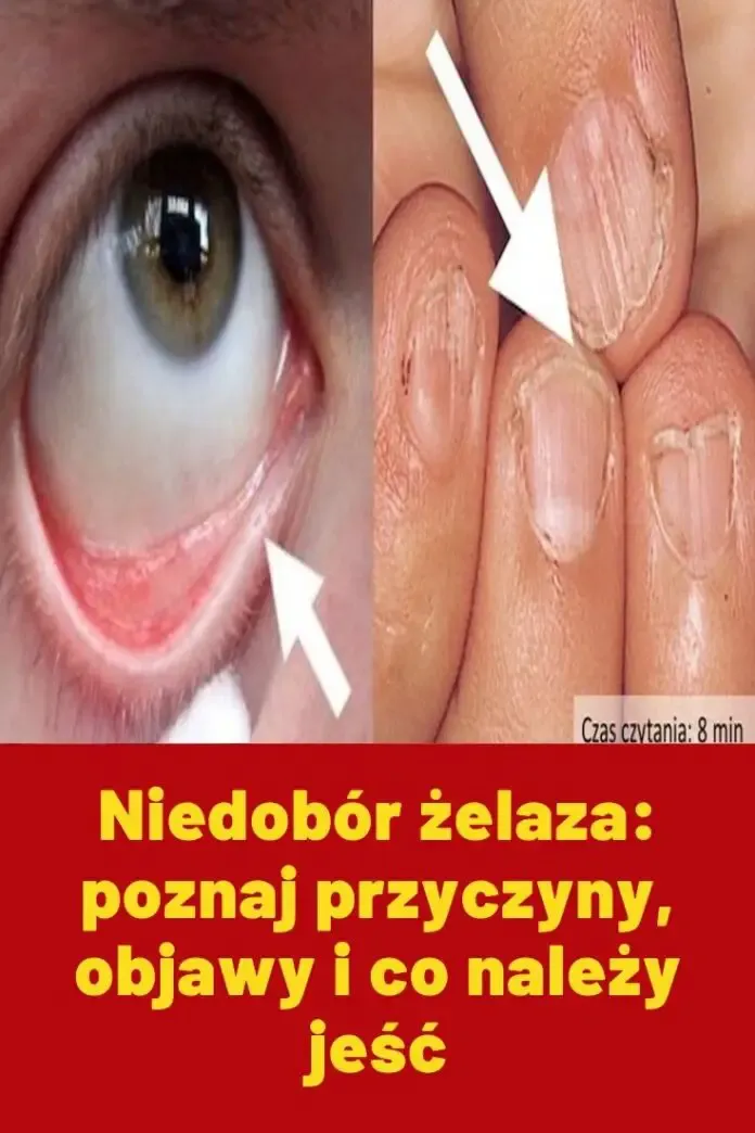 Zdjęcie Dlaczego organizm nie przyswaja żelaza? Oto najważniejsze przyczyny