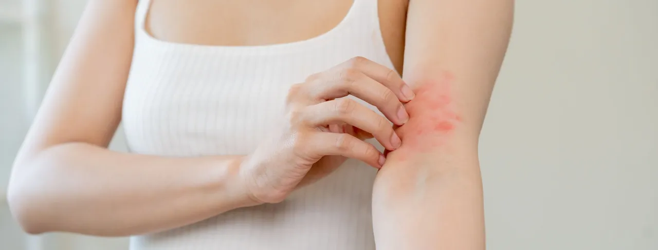 Zdjęcie Alergia na leki objawy – jak rozpoznać groźne reakcje alergiczne