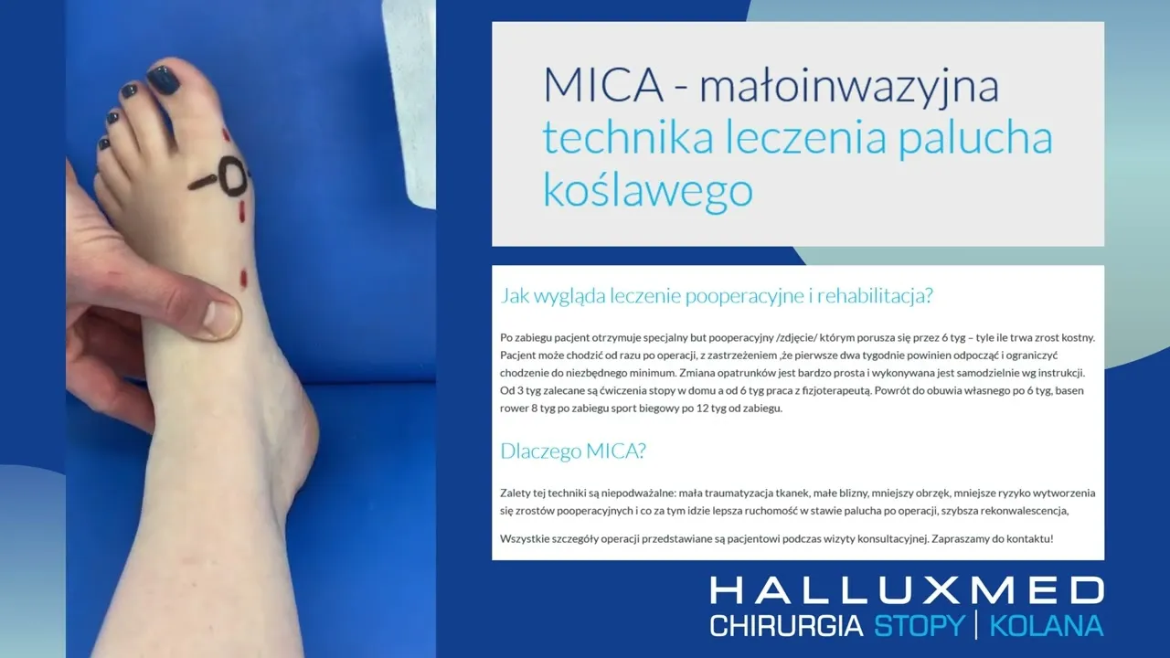 Zdjęcie Jak dbać o stopę po operacji haluksa, aby uniknąć bólu i komplikacji